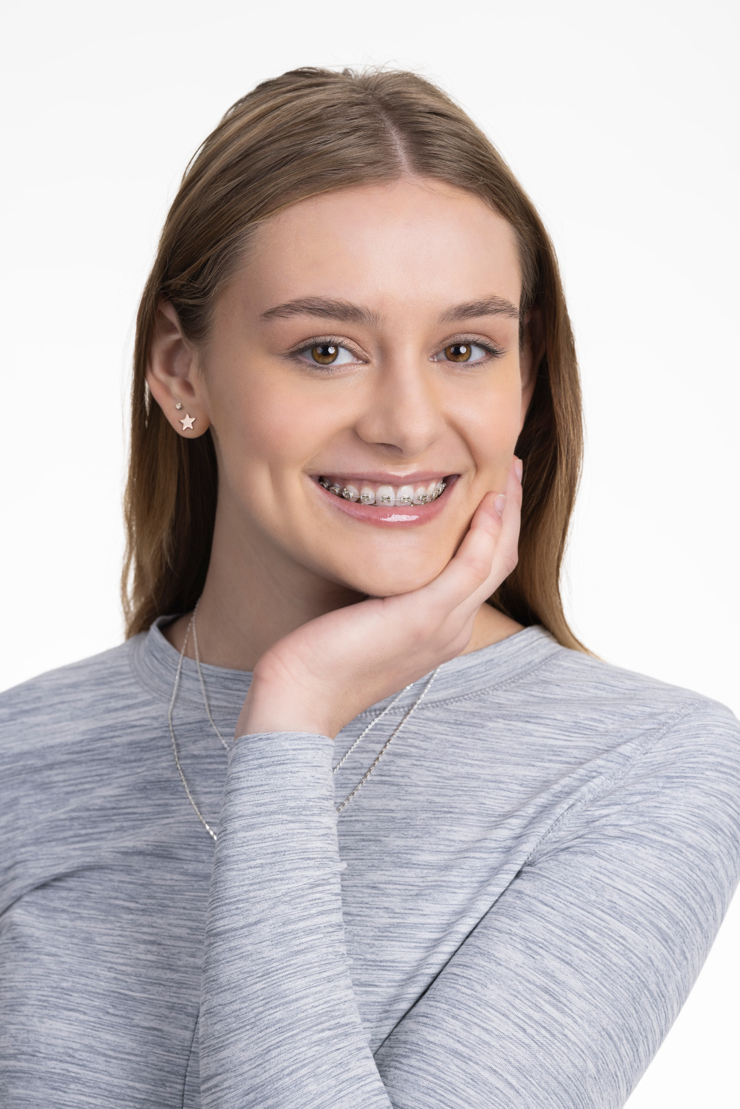 Patient wearing Iconix Champagne Gold Braces