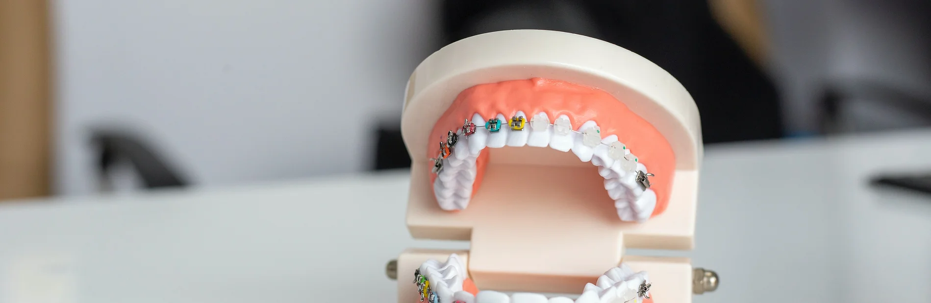 Close-up of self-ligating braces brackets on teeth