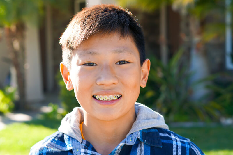 What is Phase I “Early Interceptive” Orthodontic Treatment?