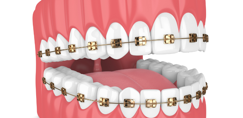 Dental model showing Iconix champagne gold braces on both the upper and lower arch