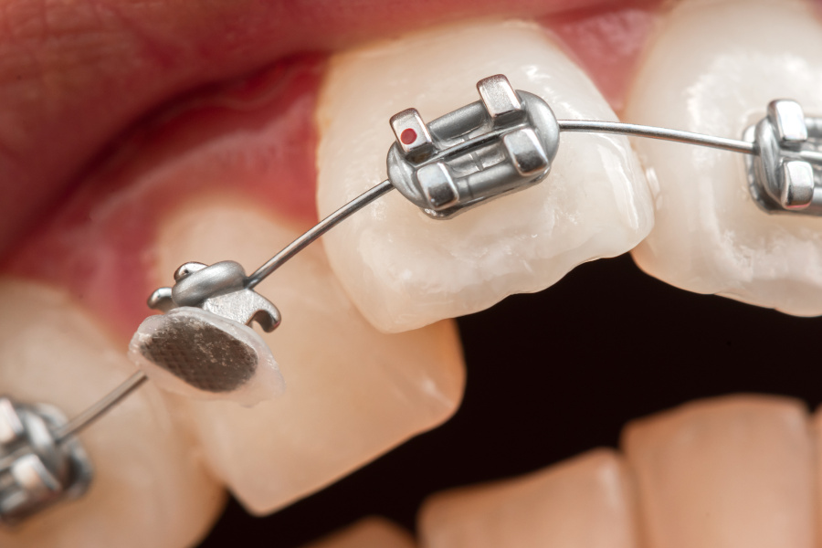 If a brace comes loose from a tooth...
