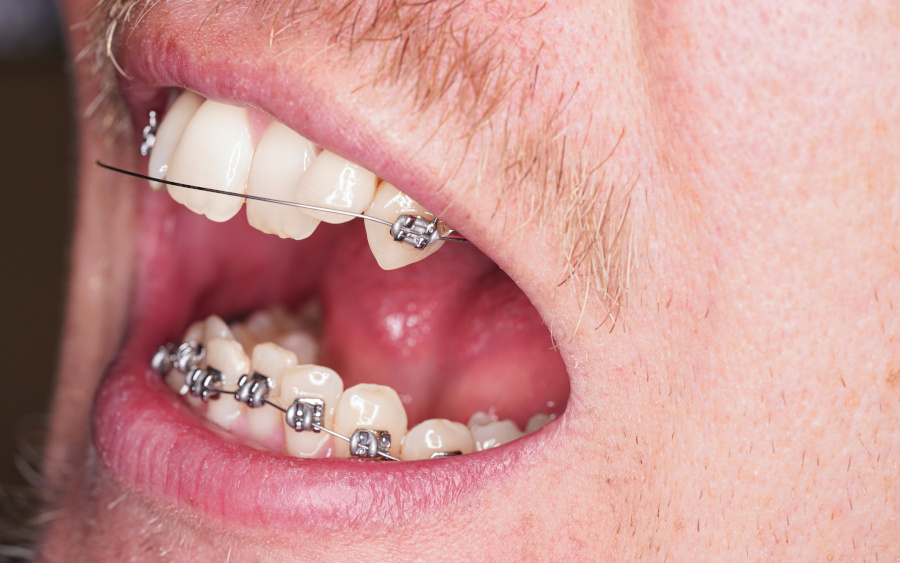 If the main wire has come out of the brace or tube on a back molar tooth...