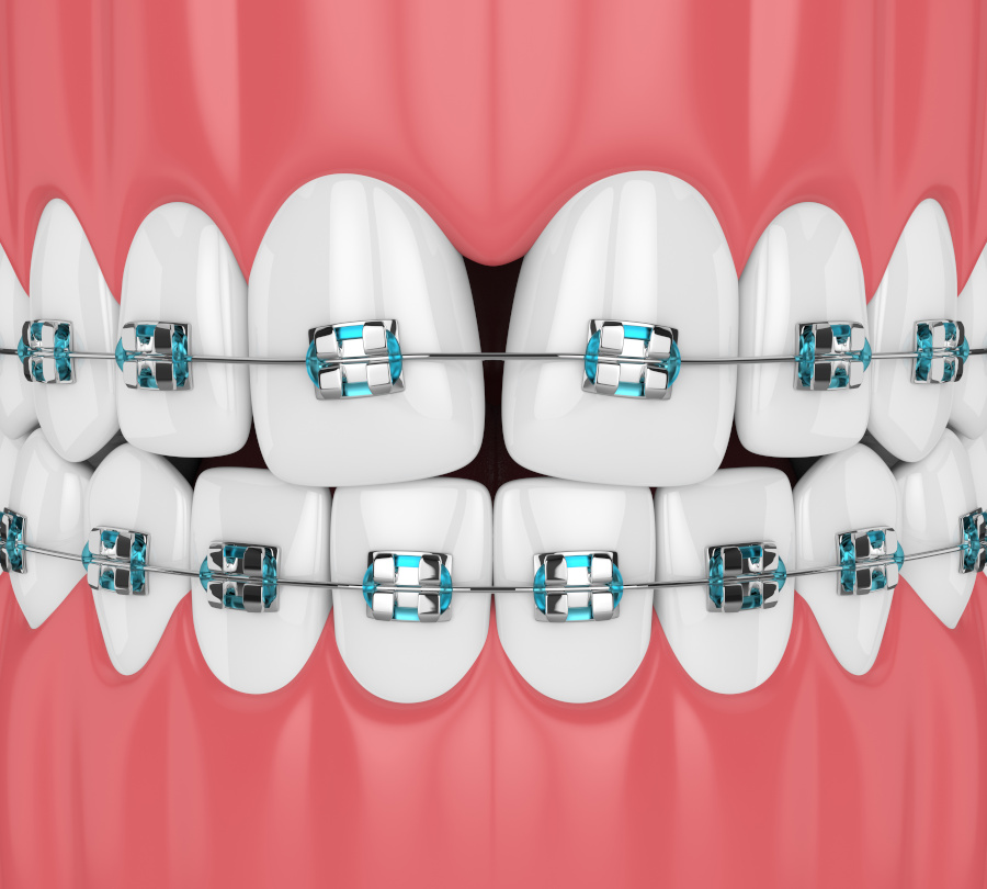 If you notice some small spaces developing between your teeth while you have braces on...